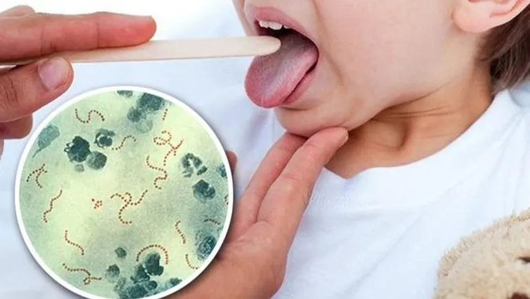 Alerta faringitis: Salud advirtió por una bacteria que ya provocó 16 muertes