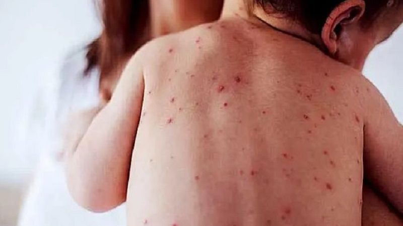 El Gobierno de la provincia de Buenos Aires encendió las alarmas ante un nuevo brote de sarampión