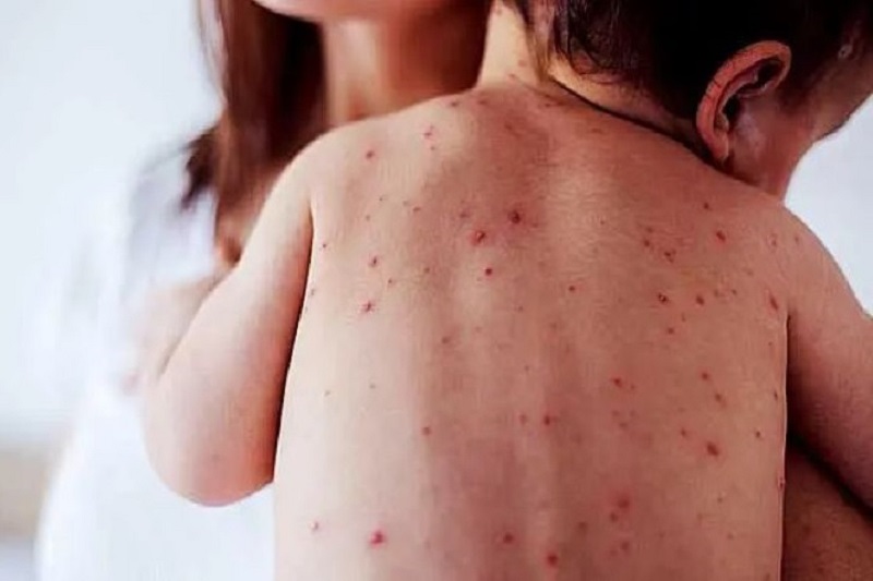 El Gobierno de la provincia de Buenos Aires encendió las alarmas ante un nuevo brote de sarampión