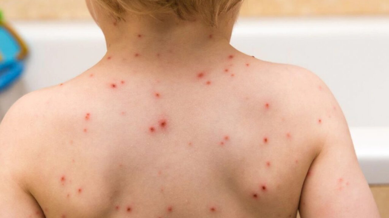 Alerta sanitaria por Sarampión en Argentina: investigan a 98 contactos de la familia rusa que viajó por ocho provincias con la enfermedad