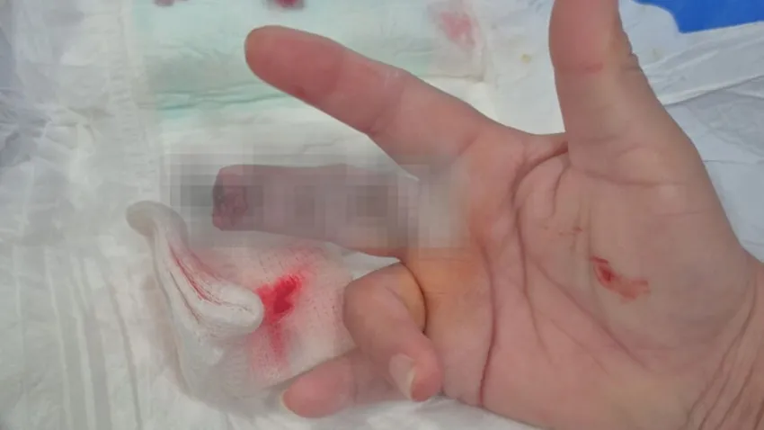 Un paciente bajo efectos de drogas atacó a una enfermera y le arrancó un dedo de un mordisco