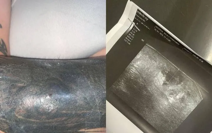 Docente trans denunció mala praxis y un brutal ataque transfóbico tras un tatuaje infectado